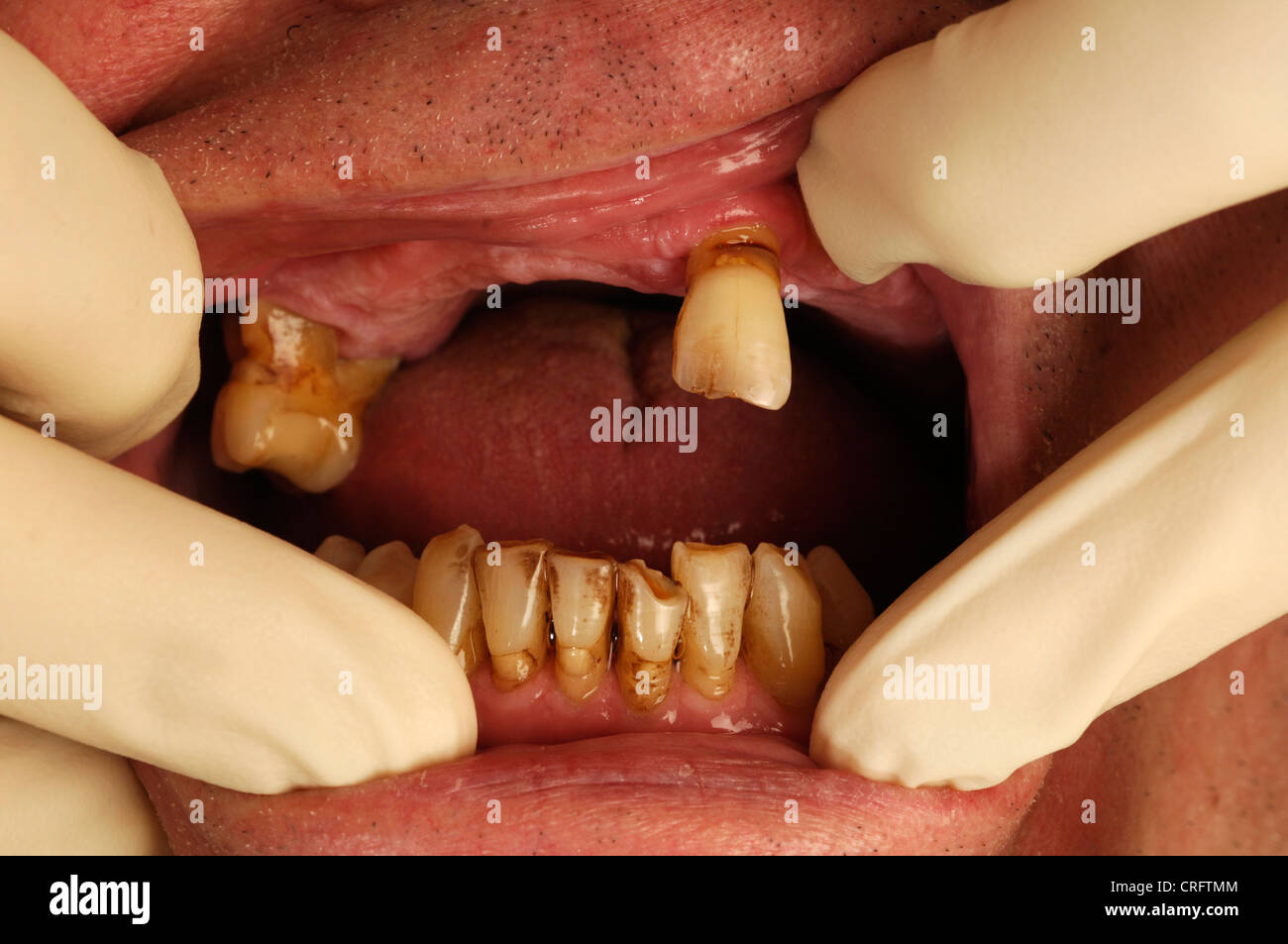Un uomo anziano i denti di essere esaminato da un dentista. Foto Stock