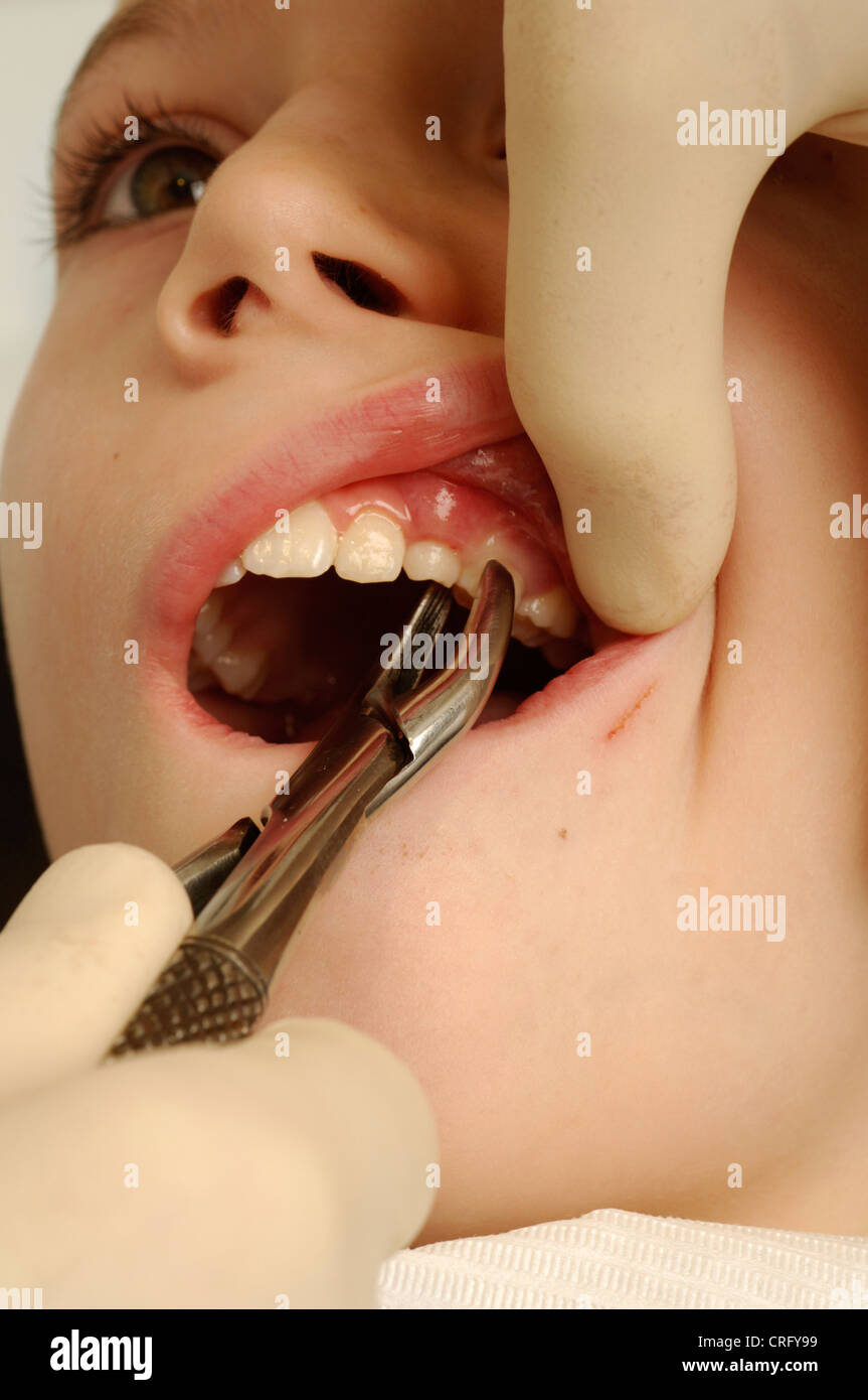 In prossimità di un dente che viene estratto. Foto Stock