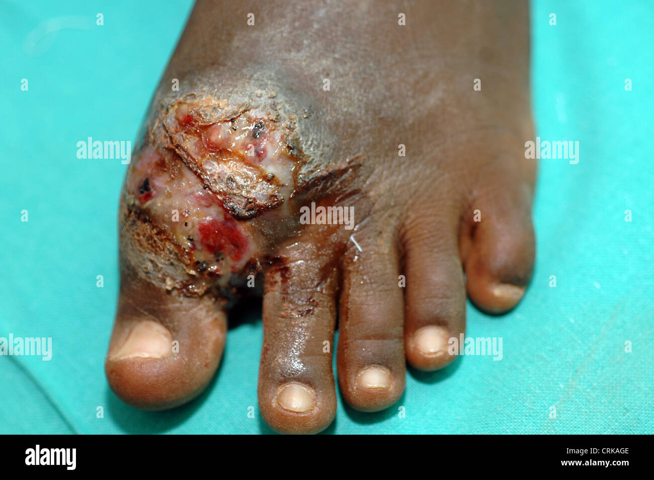 Mycetoma progressivo infiammatorio Diseas Soft Tissue Granuloma rigonfiamento punta gonfia le dita dei piedi Foto Stock