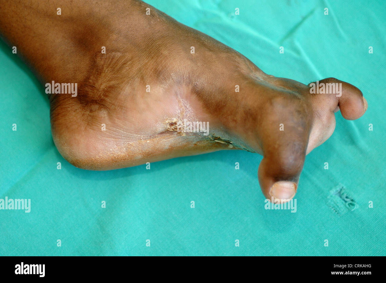 Piede di Madura Mycetoma progressivo infiammatorio del tessuto molle Granuloma tropicale malattia Foto Stock