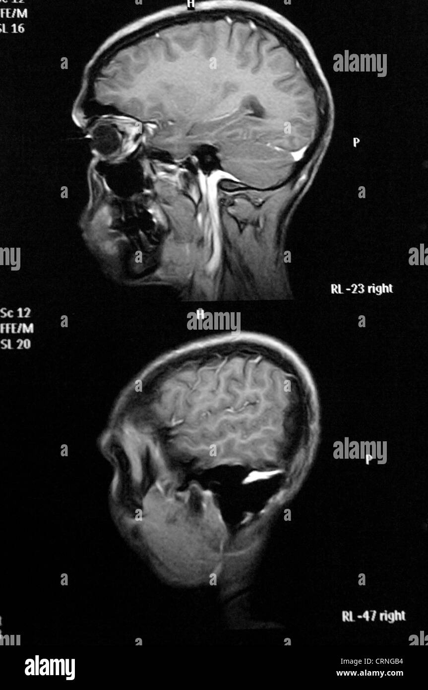 I raggi x di una testa di pazienti e cervello Foto Stock