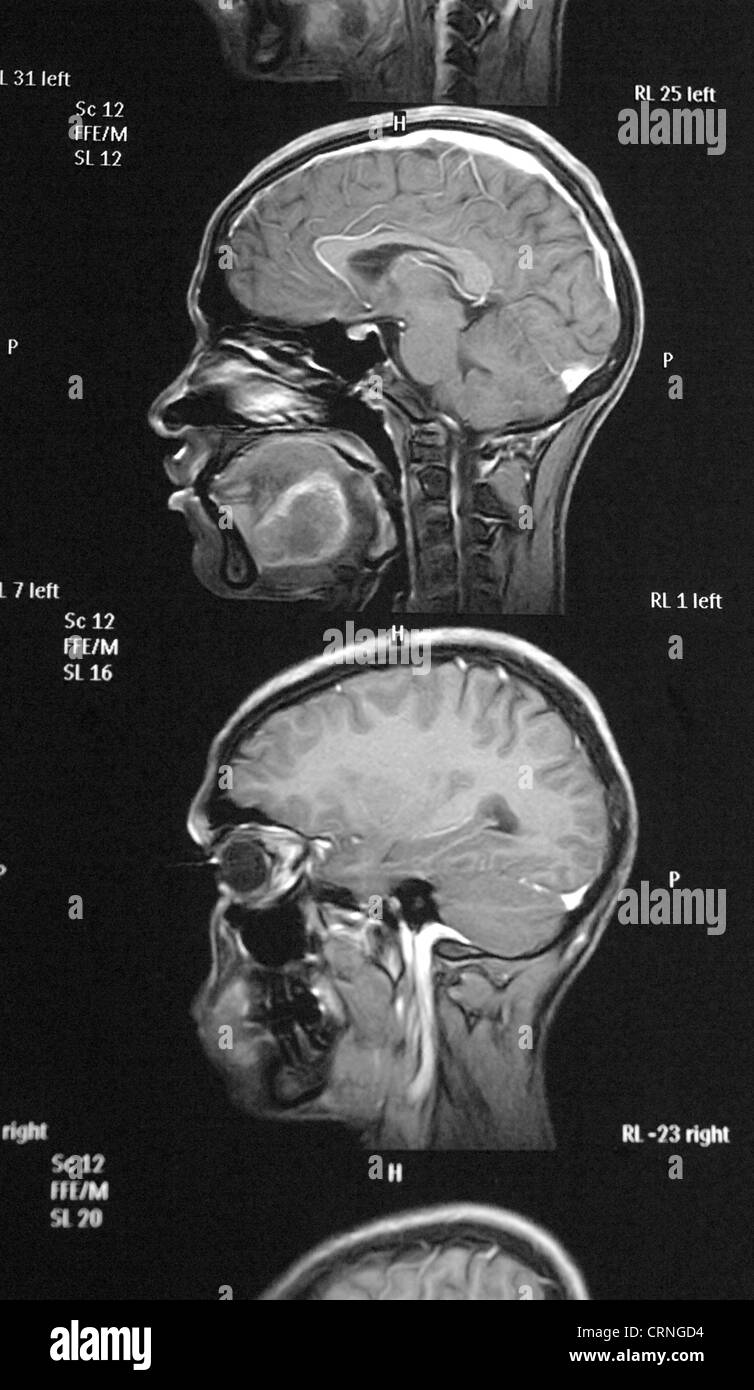 X-ray di qualcuno con cancro al cervello Foto Stock