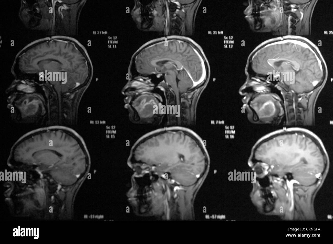 Imaging a risonanza magnetica (MRI) Scansione del cranio che mostra il mieloma. Il mieloma o il mieloma multiplo è un tipo di cellula plasmatica cancro, immune alle cellule del sistema nel midollo osseo. Foto Stock