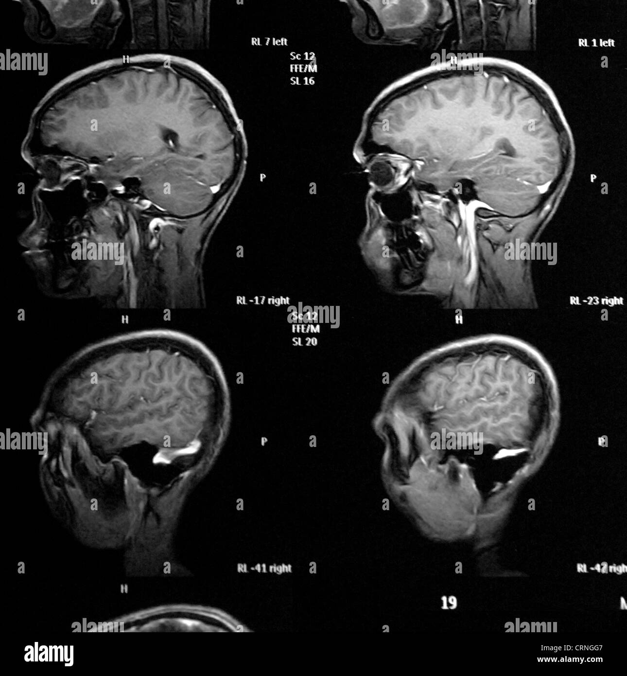X-ray del paziente con cancro al cervello Foto Stock