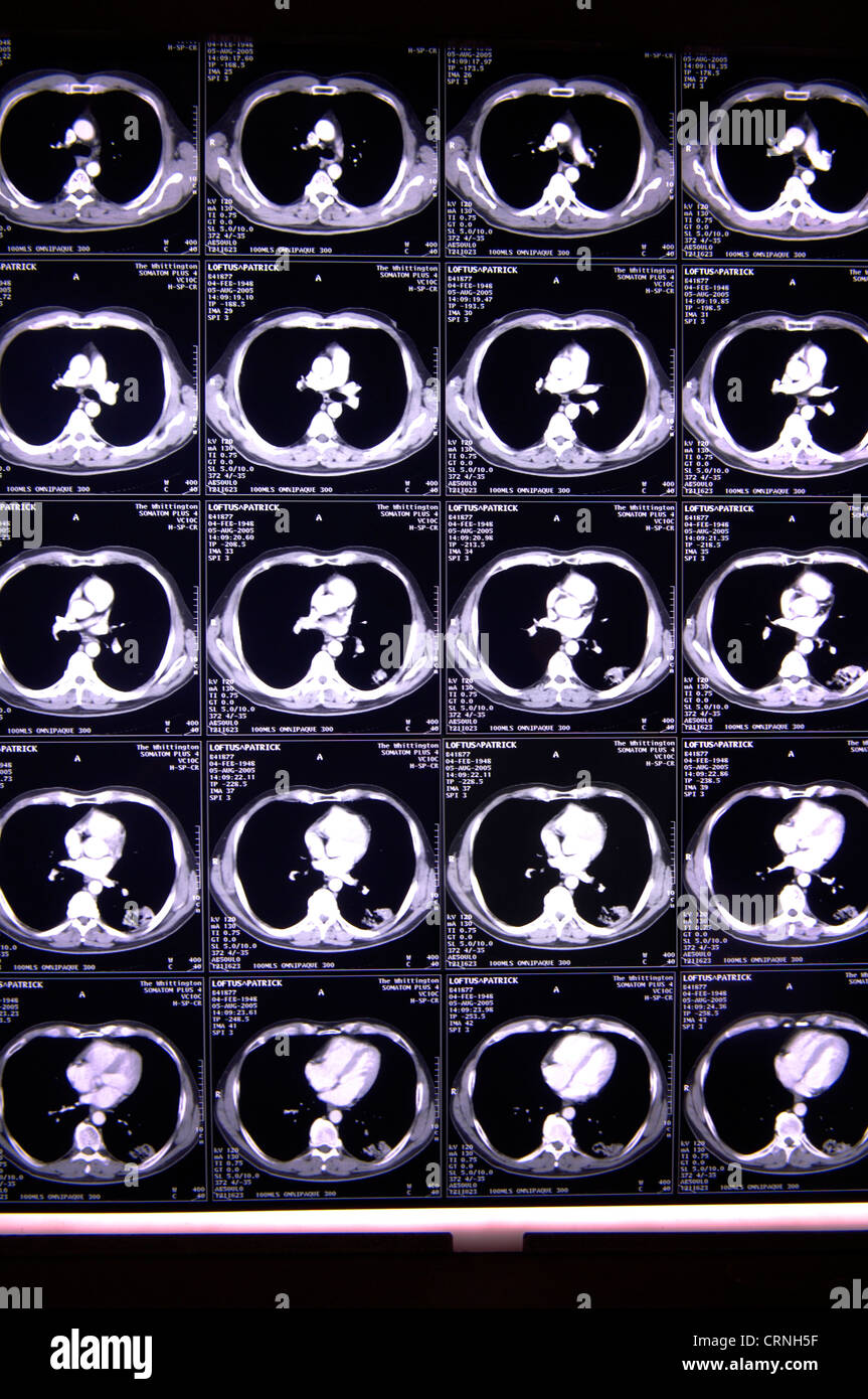 Cat scan della corteccia cerebrale Foto Stock