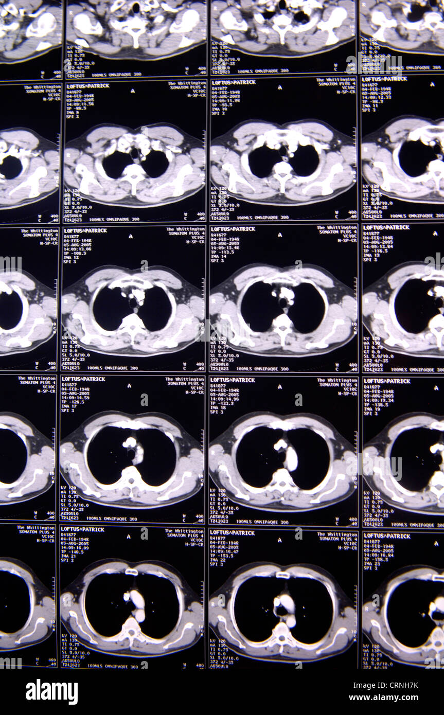 Cat scan della corteccia cerebrale Foto Stock