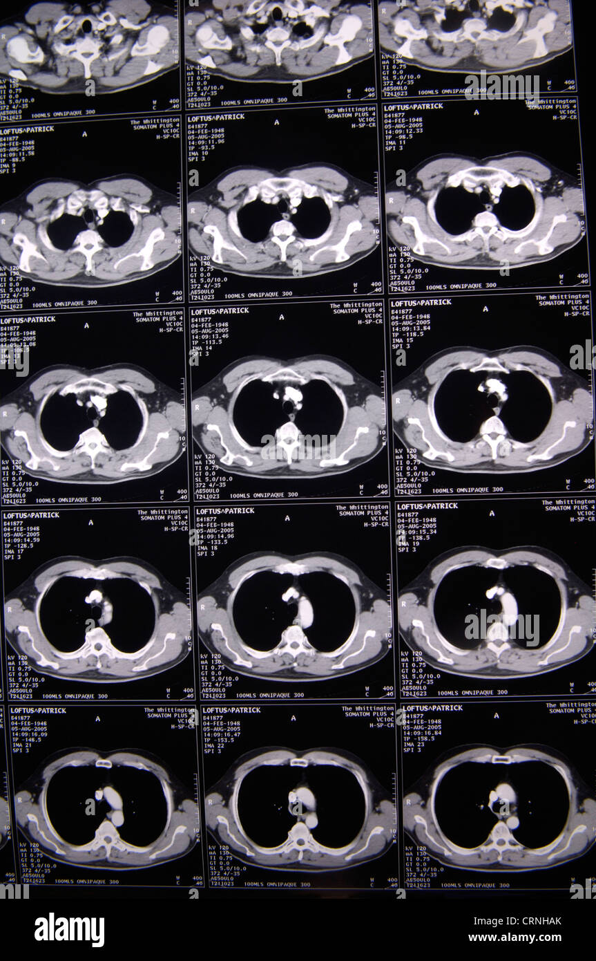 Cat Scan della corteccia cerebrale Foto Stock