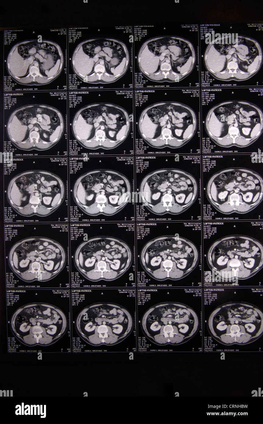 Cat scan della corteccia cerebrale Foto Stock