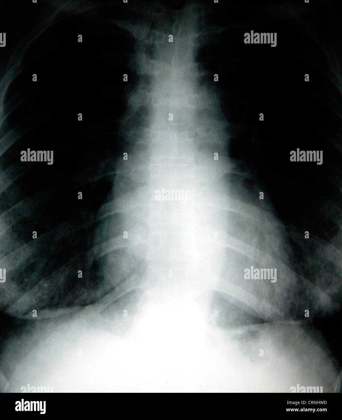 Raggi X di un uomo in una gabbia toracica. Foto Stock