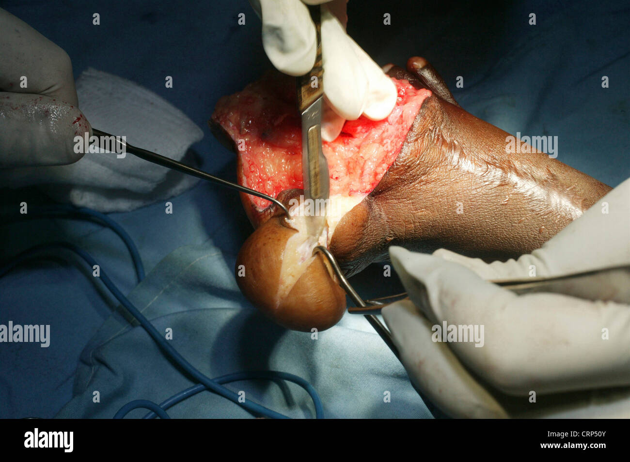 I chirurghi rimuovere tessuto morbido durante la chirurgia correttiva su un piede deformato. Foto Stock