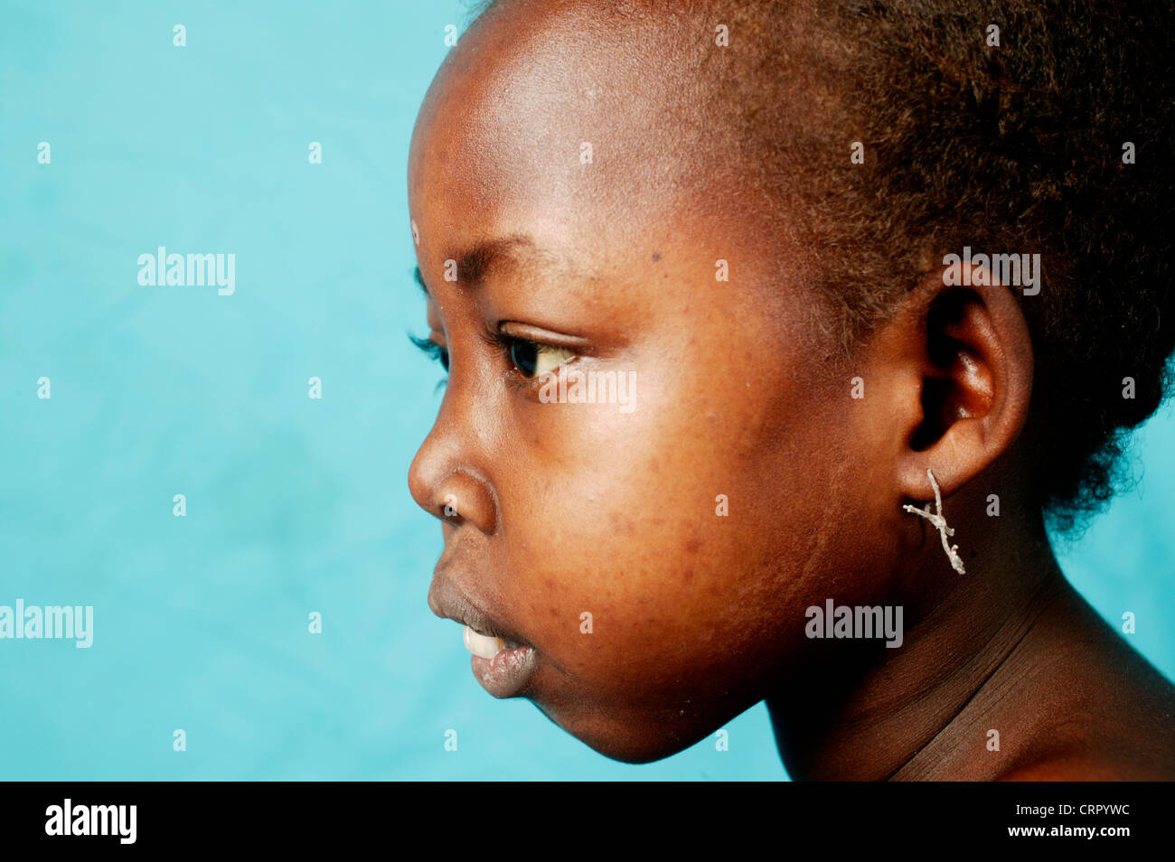 Vista laterale del volto di un 12 anni ragazza affetti da sindrome nephritic e anemia falciforme Foto Stock