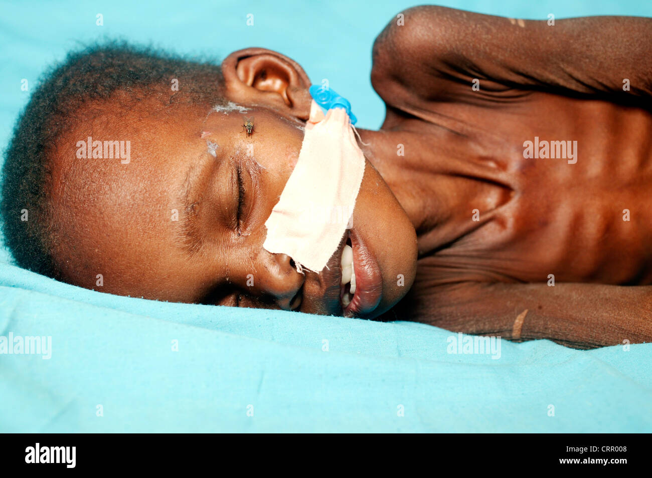 Un bambino di 2 anni ragazzo soffre di grave malnutrizione con grave wastening e la perdita di grasso sottocutaneo. Foto Stock