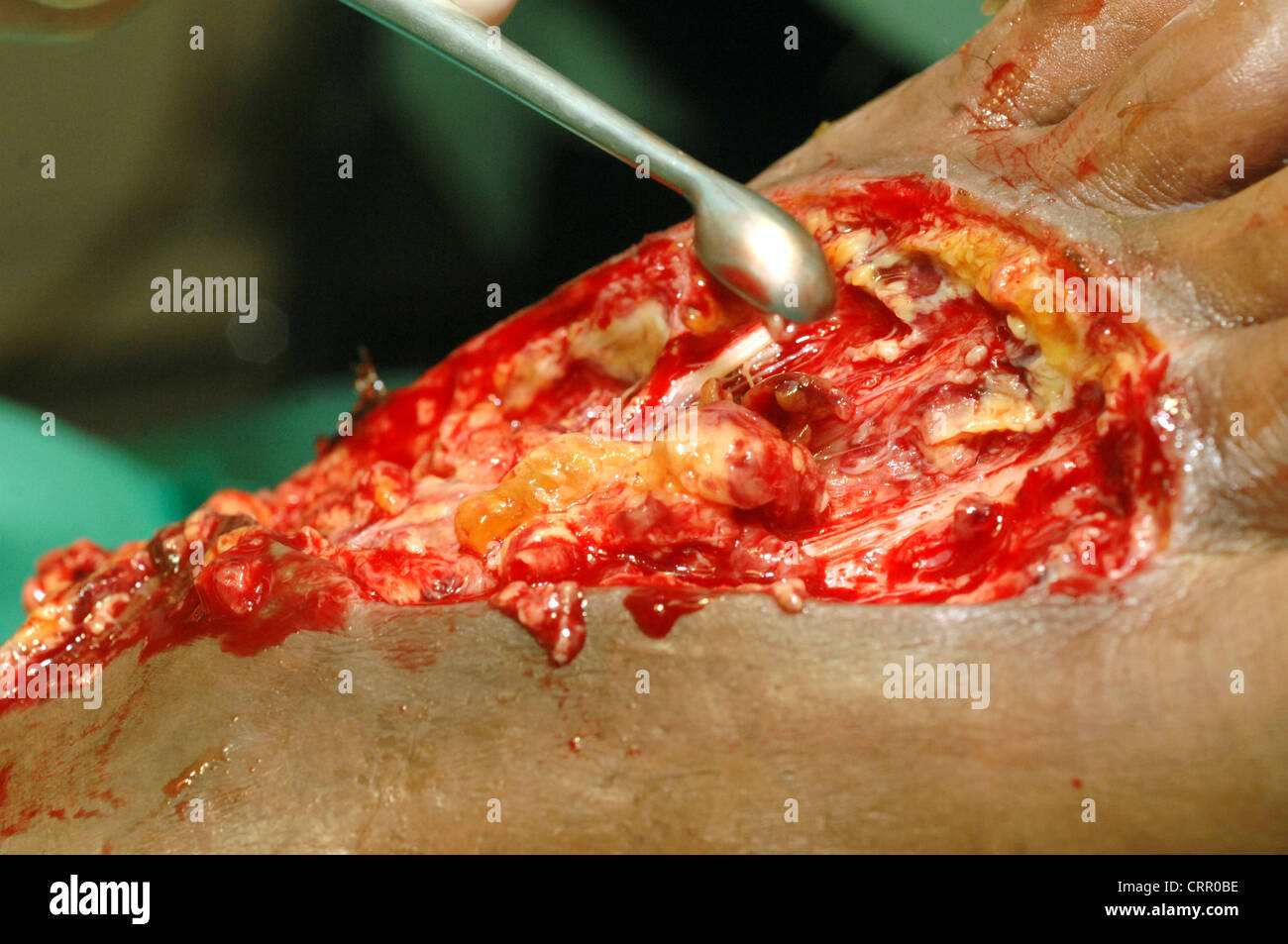 Chirurgia su un piede con cella di decadimento. Foto Stock