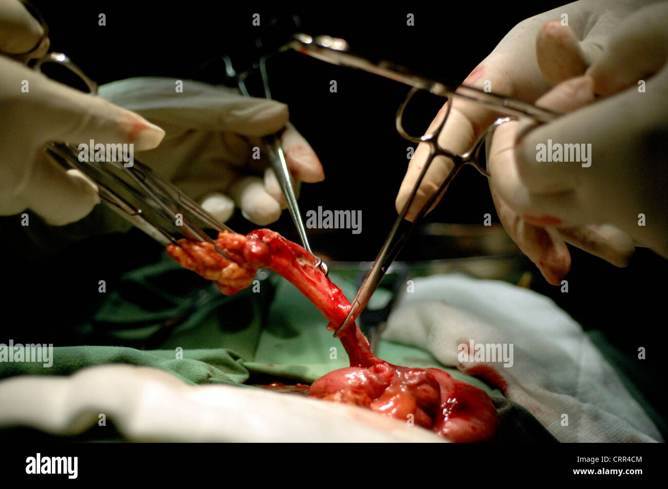 Rimozione di tessuto durante la chirurgia Foto Stock