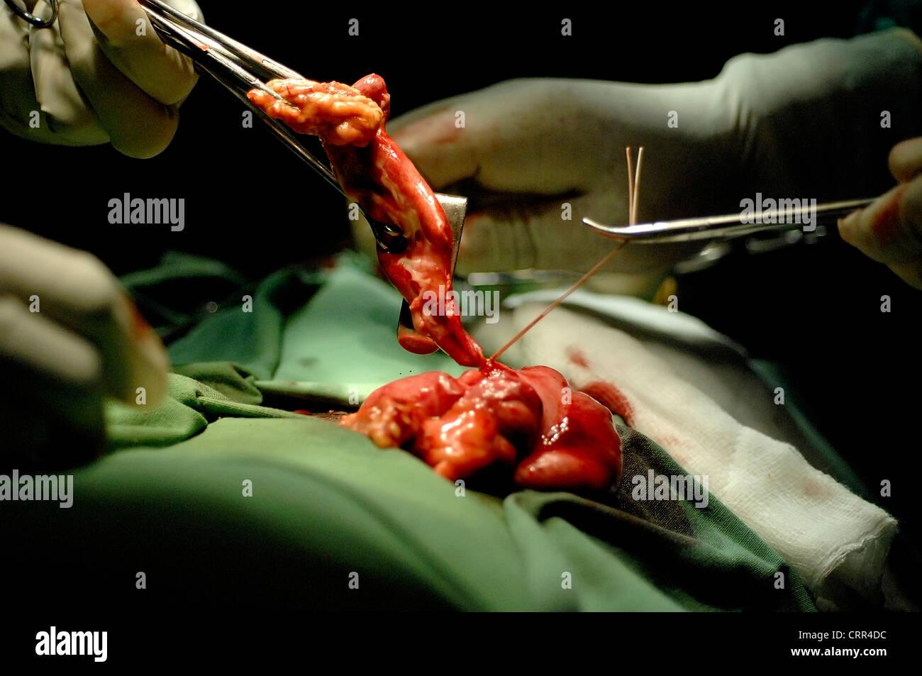 Rimozione di tessuto durante la chirurgia Foto Stock