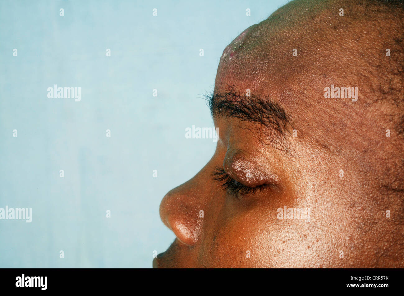 Adolescente arterie africana sul fronte Foto Stock