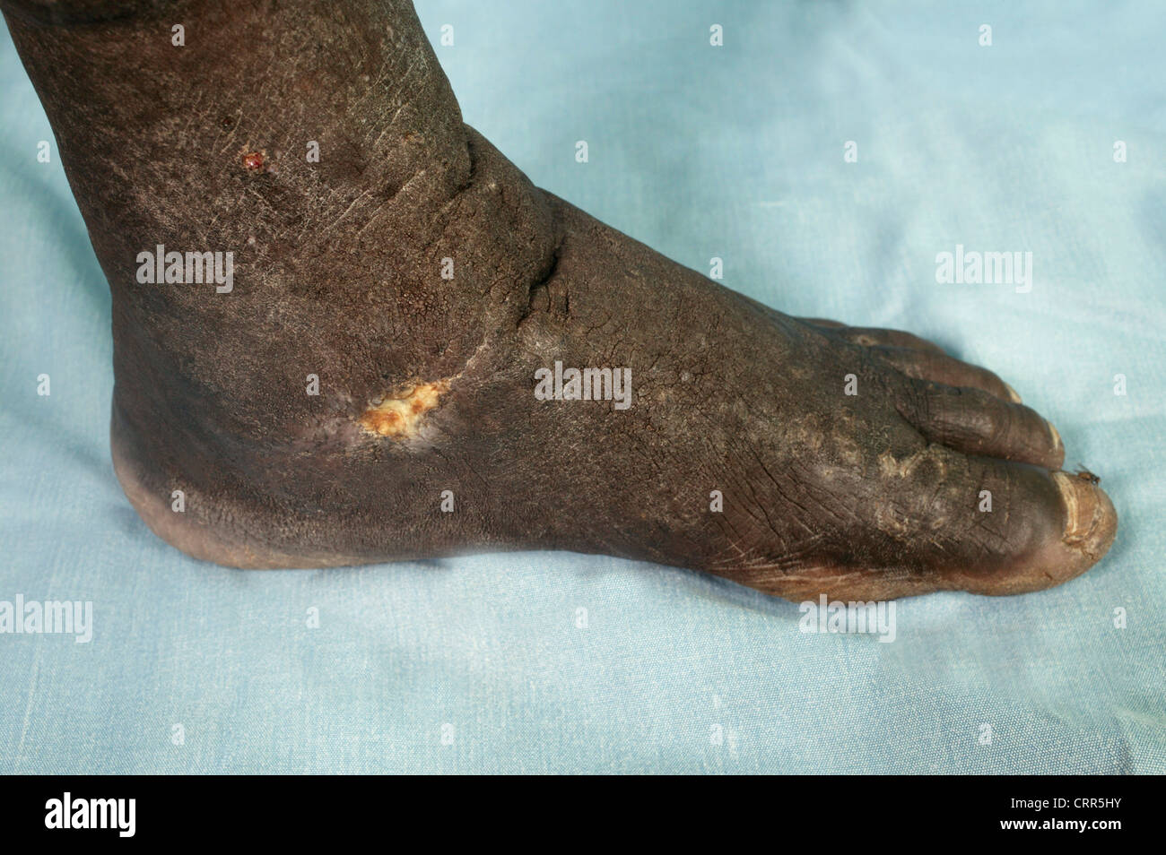 Mal tagliati e Piede Infetto Foto Stock