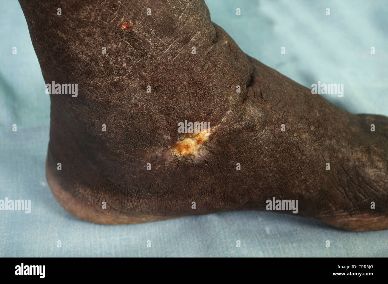 Mal tagliati e Piede Infetto Foto Stock