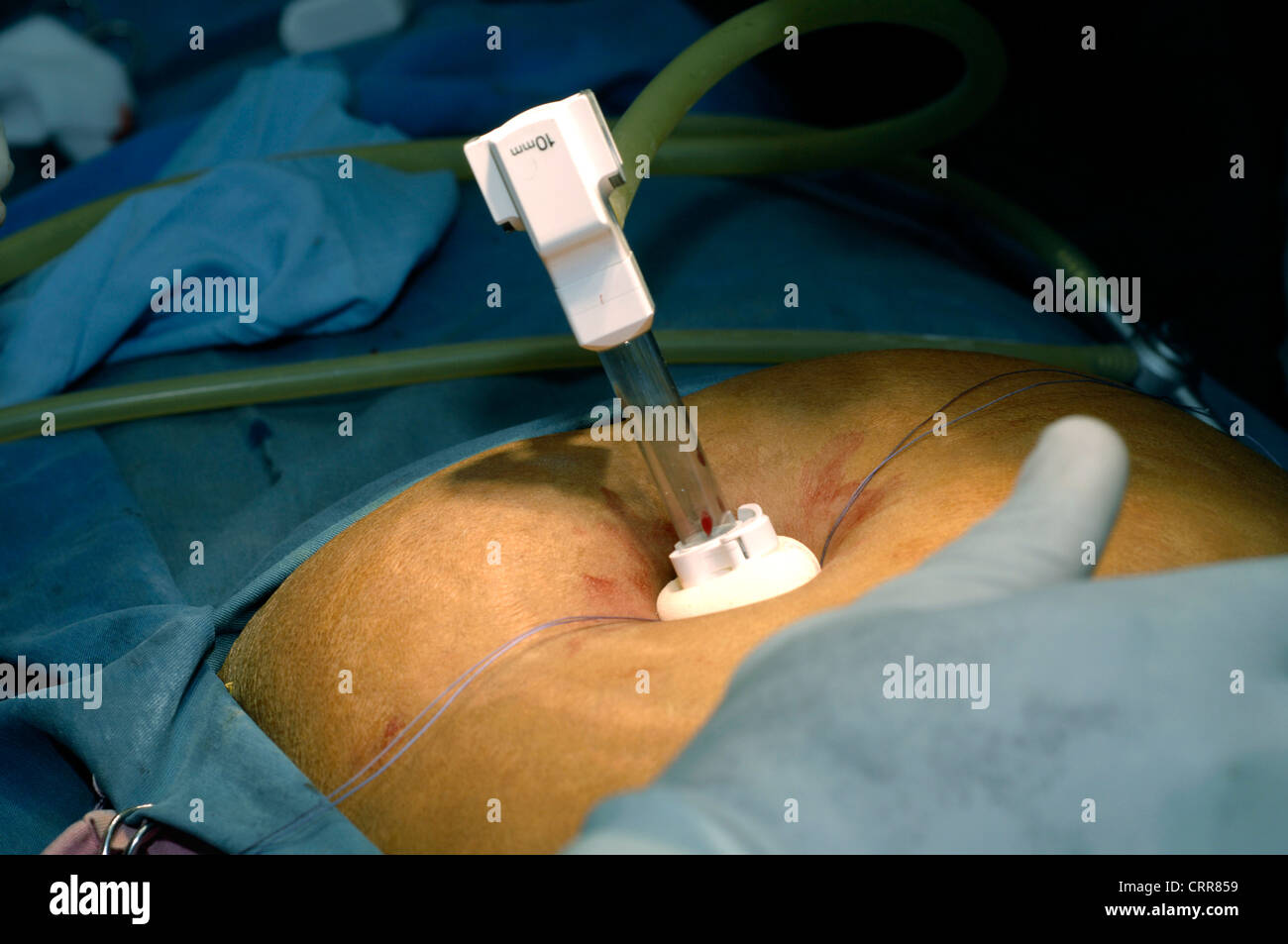 La cistifellea pietre distacco. Foto Stock