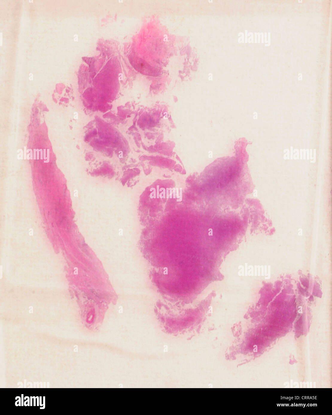 La citologia diapositiva che mostra il melanoma maligno. Foto Stock