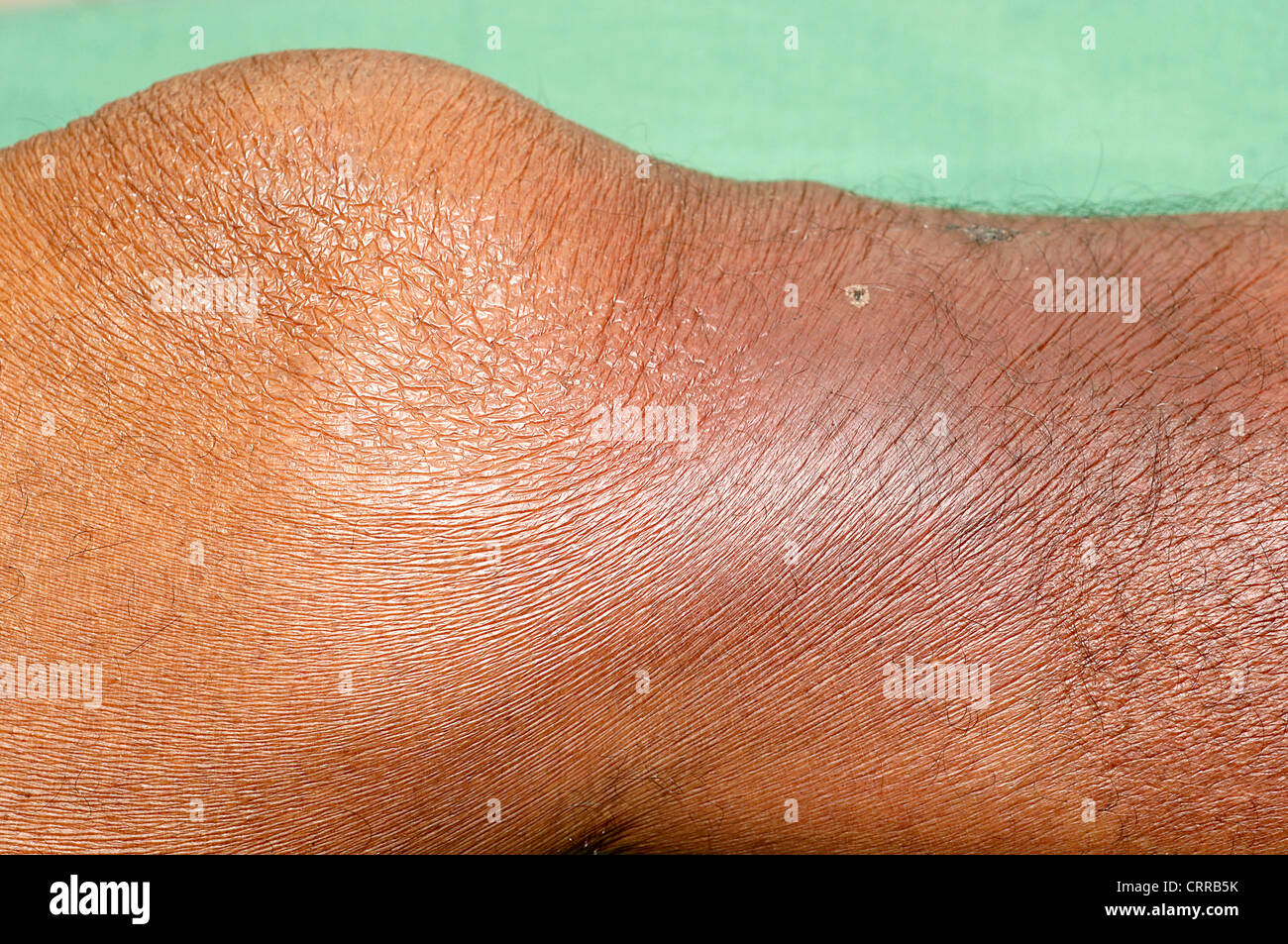 Close-up di un ginocchio umano con ammaccature dovute a cause sconosciute. Foto Stock