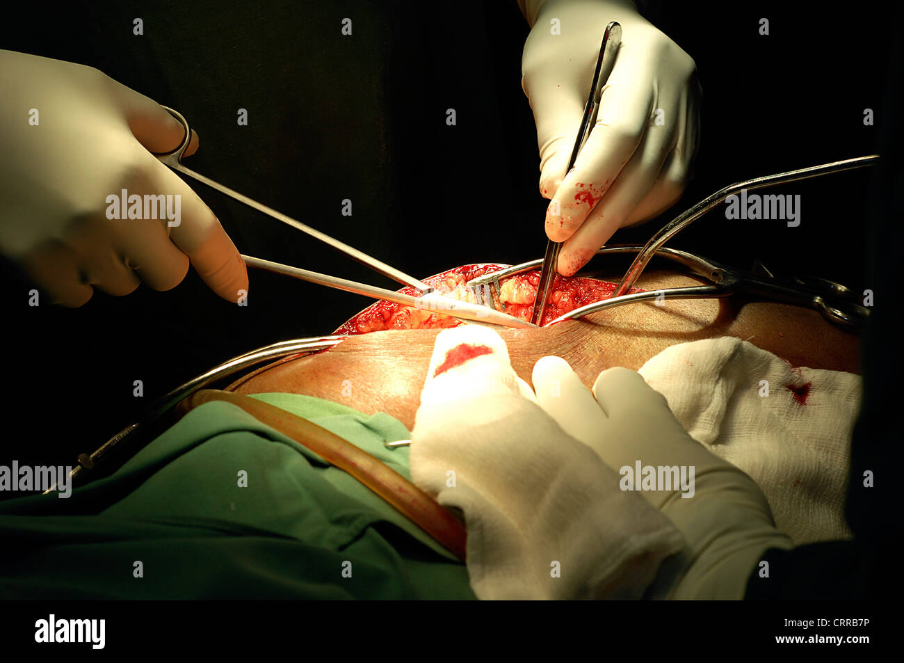 Chirurgia sostitutiva dell'anca Foto Stock