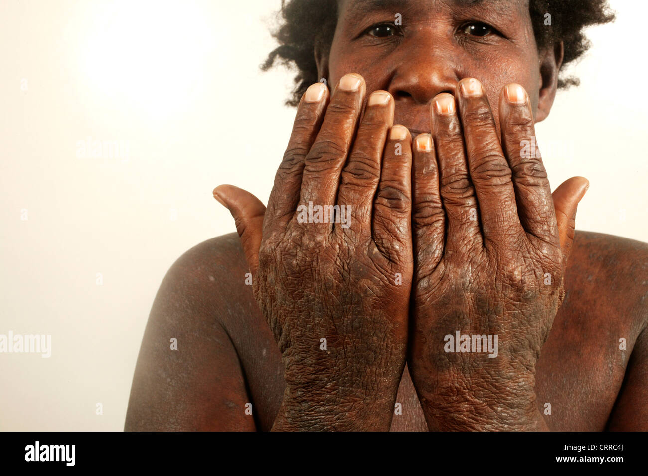 Una donna con una condizione della pelle delle mani. Foto Stock