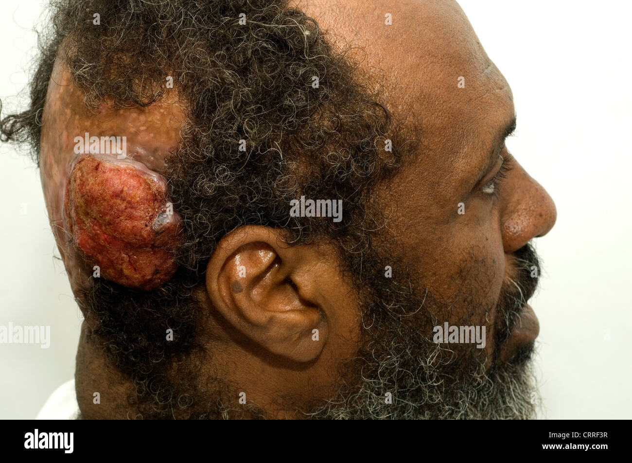 Un uomo con un carcinoma sebacea del cuoio capelluto e disegni alopecia. Foto Stock