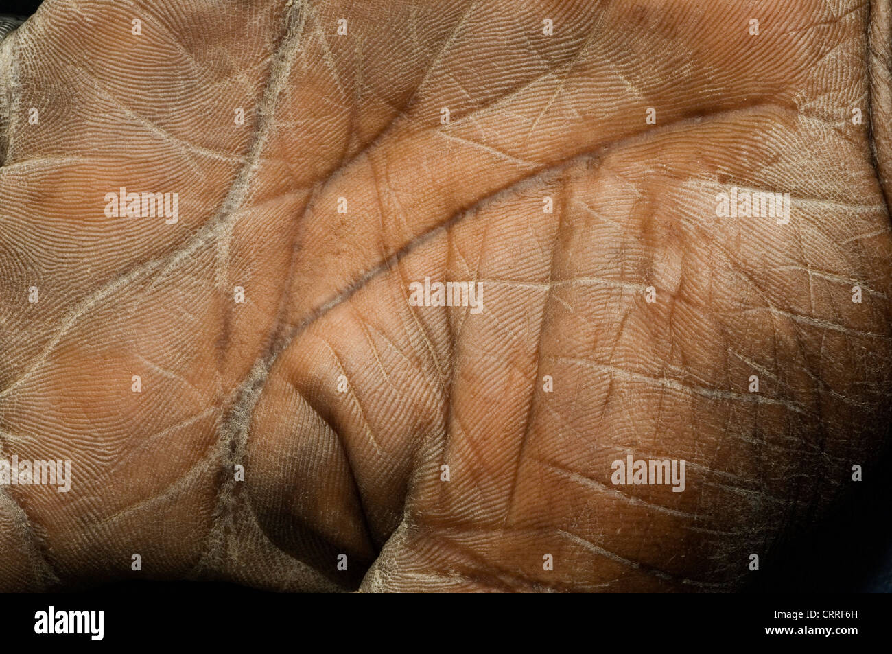 Un paziente con ittiosi volgare che incida sulla sua mano. Foto Stock