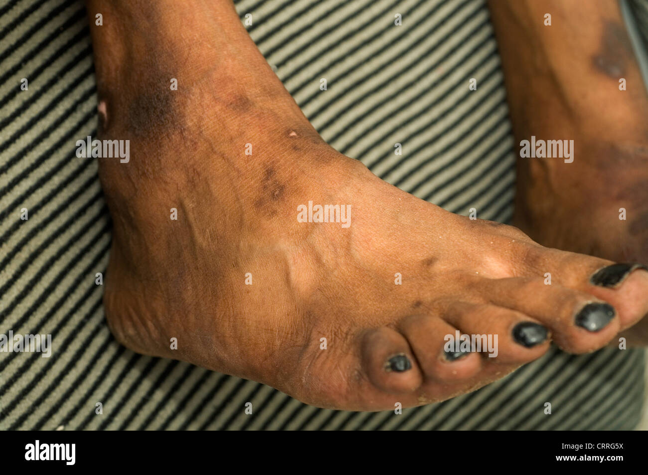 Un paziente con mycetoma (Madura piedi) Foto Stock