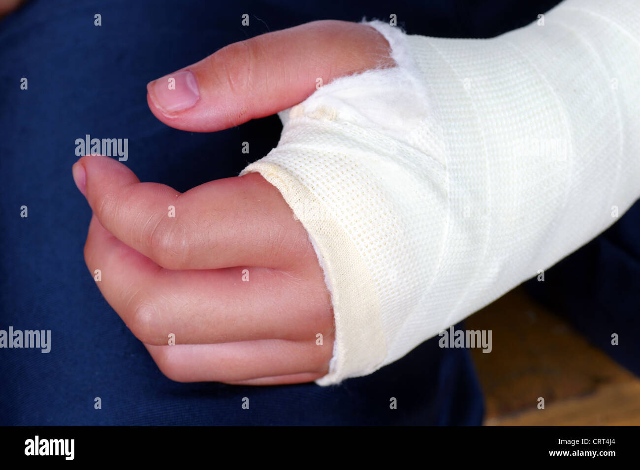 Rotture di mano nel calco in gesso con bende, rosso, gonfiore delle dita  dopo un intervento per fissare le ossa in luogo Foto stock - Alamy