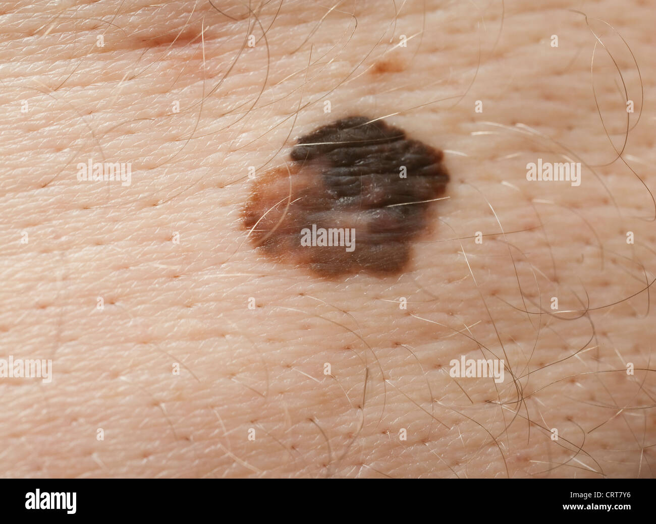 Una grande mole su un uomo con la schiena che presentano segni di melanoma, confermato più tardi. Foto Stock