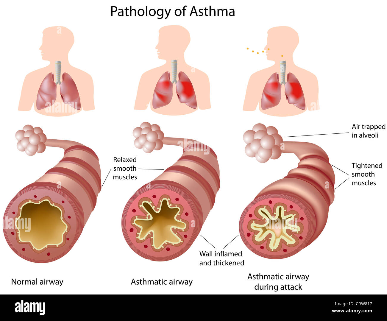 Anatomia di asma. Una sana Airways asmatici versus airways Foto Stock