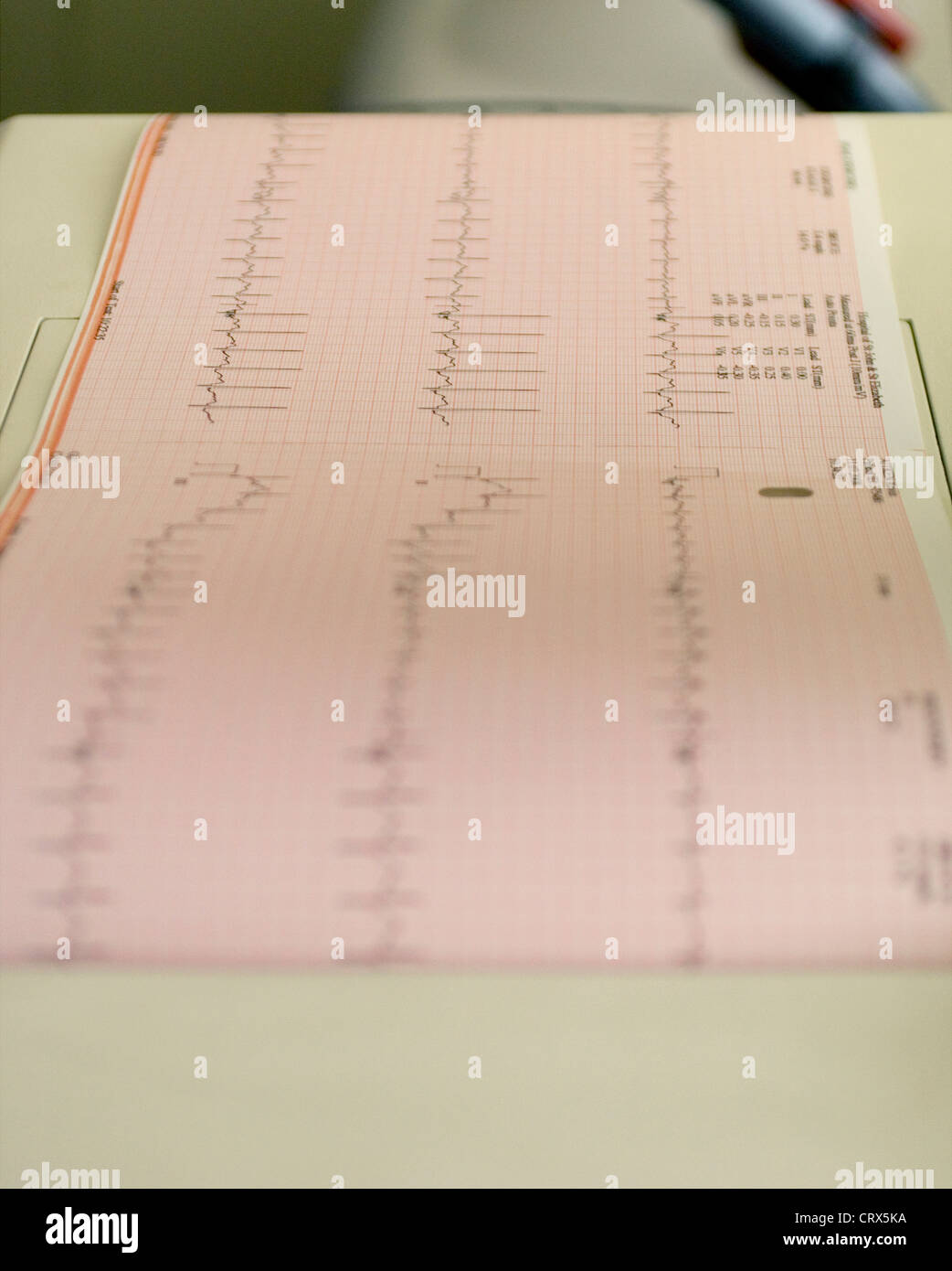 Un elettrocardiogramma registrazione dei pazienti un ciclo cardiaco prodotta da un elettrocardiografo Foto Stock