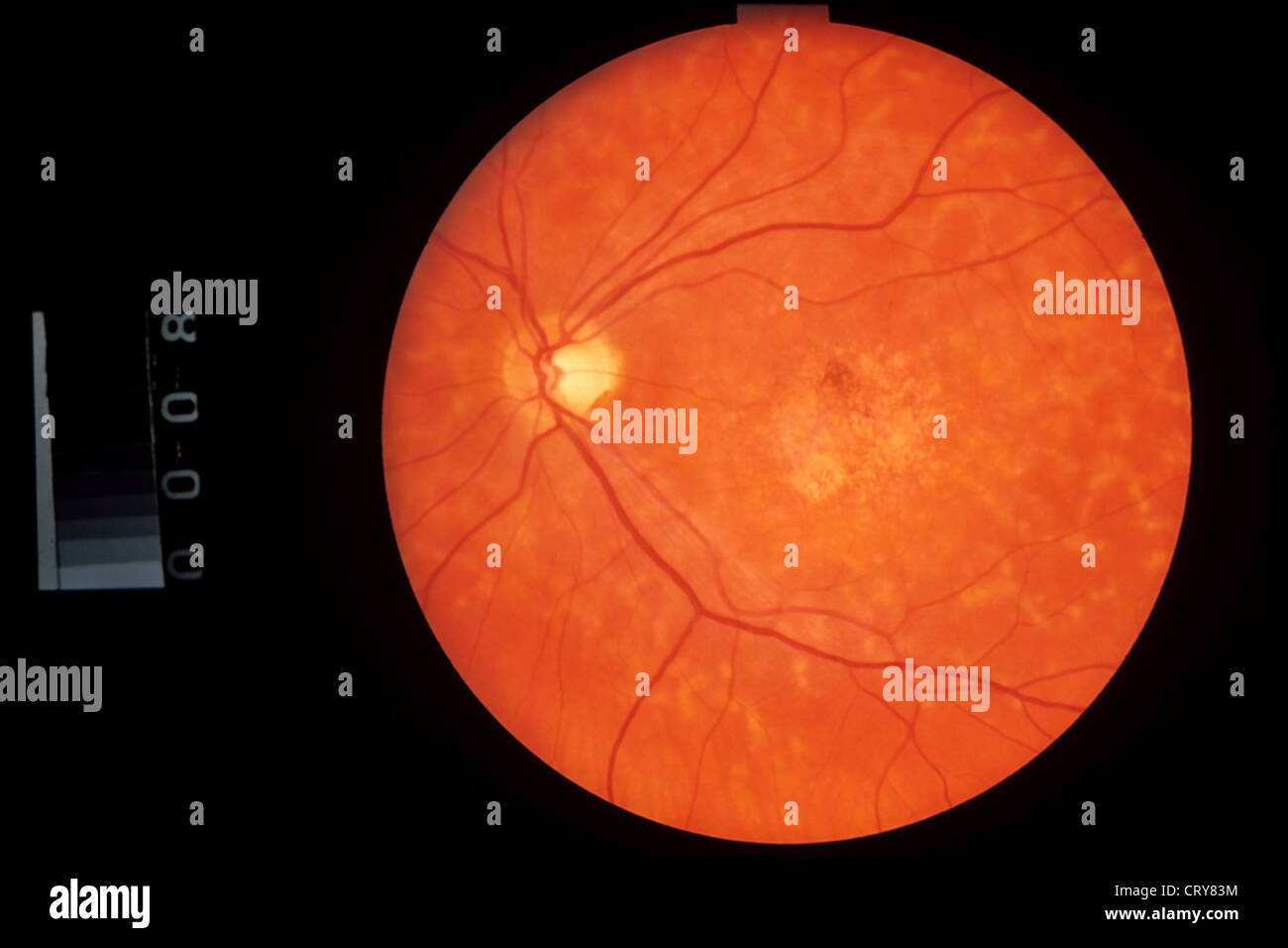 Malattia Stargardt Immagini e Fotos Stock Alamy