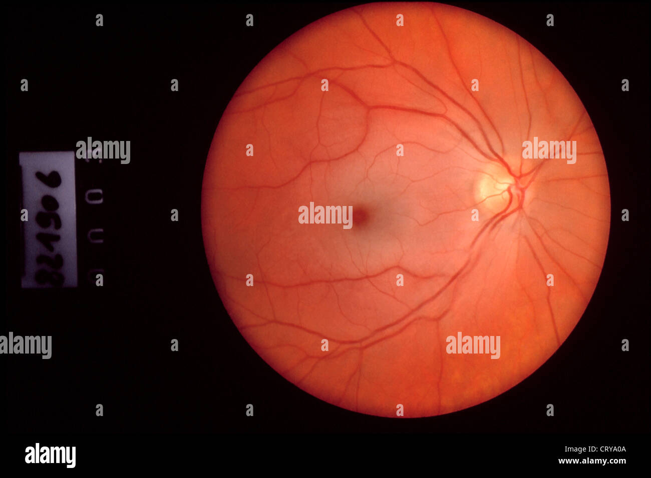 Trombosi retinica Foto Stock