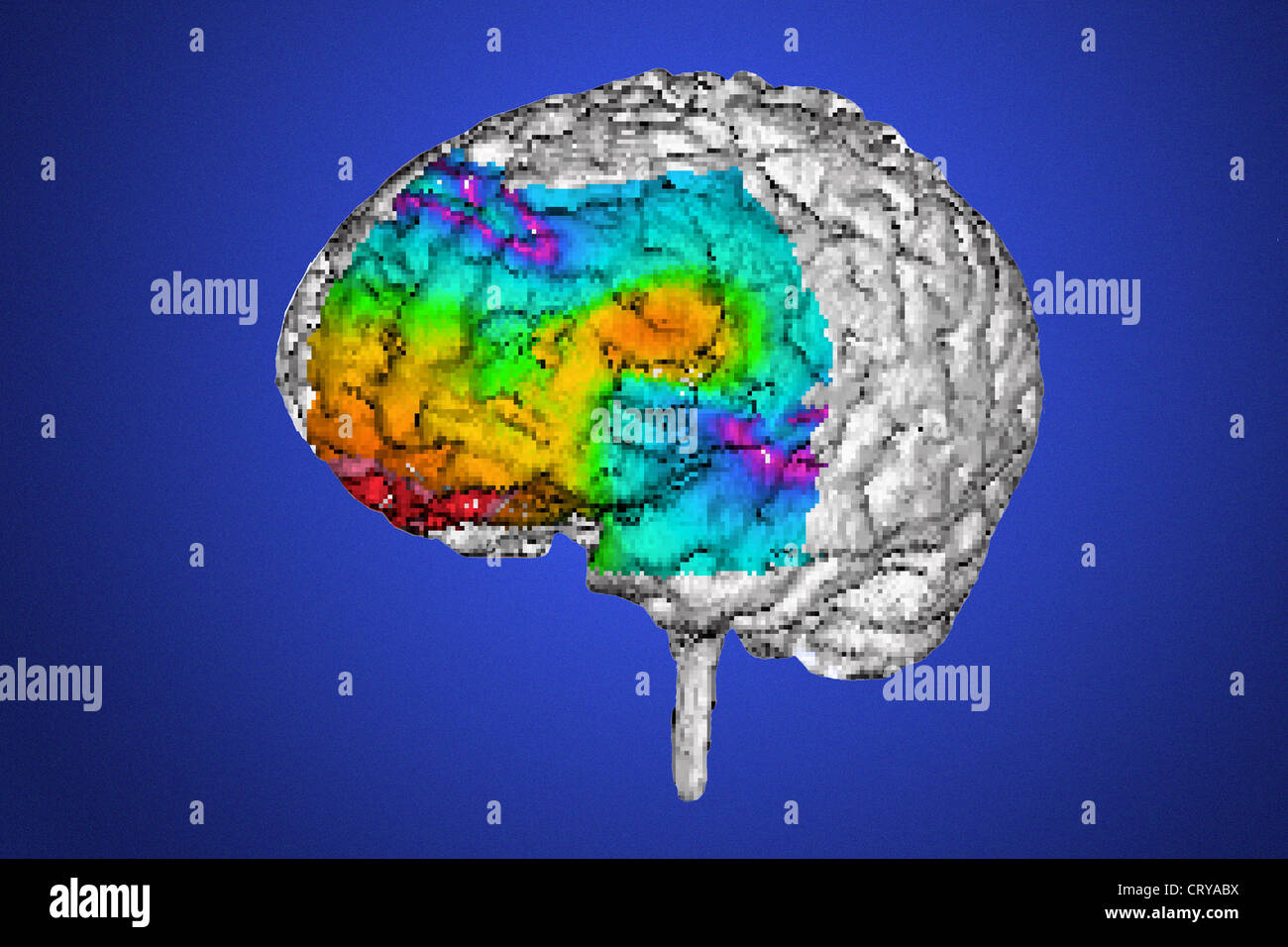 EPILESSIA, MRI Foto Stock