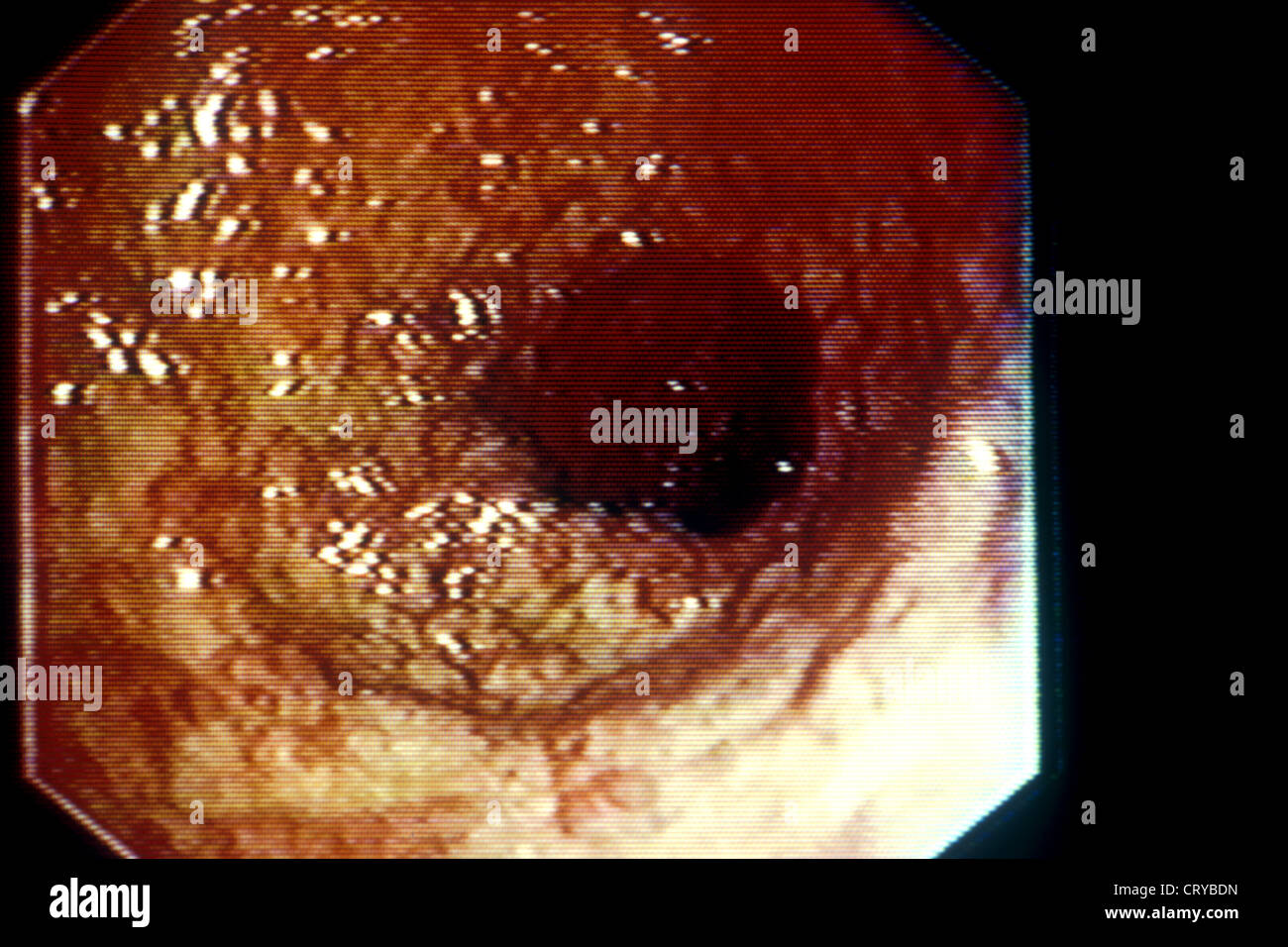 La colite ulcerosa, endoscopia Foto Stock