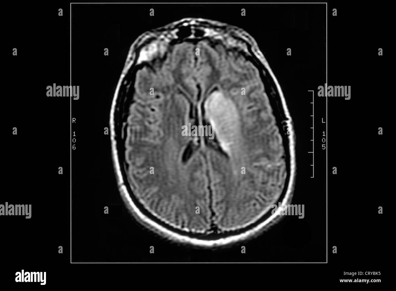 Malattia cerebrovascolare, MRI Foto Stock