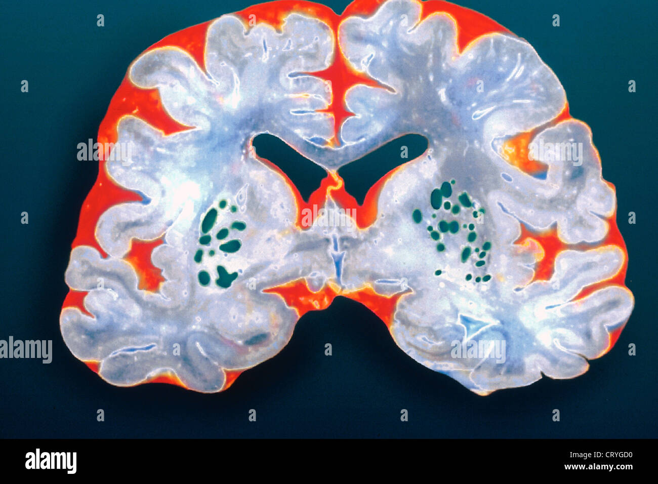 Il MORBO DI ALZHEIMER, disegno Foto Stock