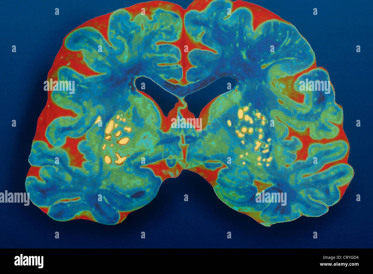Il MORBO DI ALZHEIMER, disegno Foto Stock