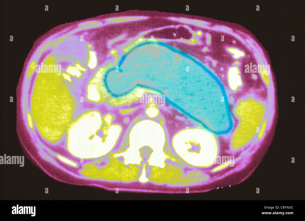La pancreatite acuta, scansione Foto Stock