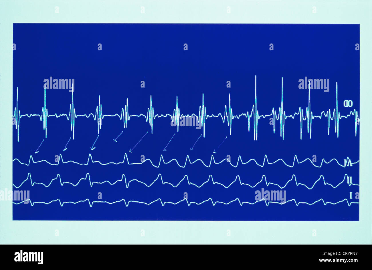 PAROXYSTIC tachicardia atriale Foto Stock