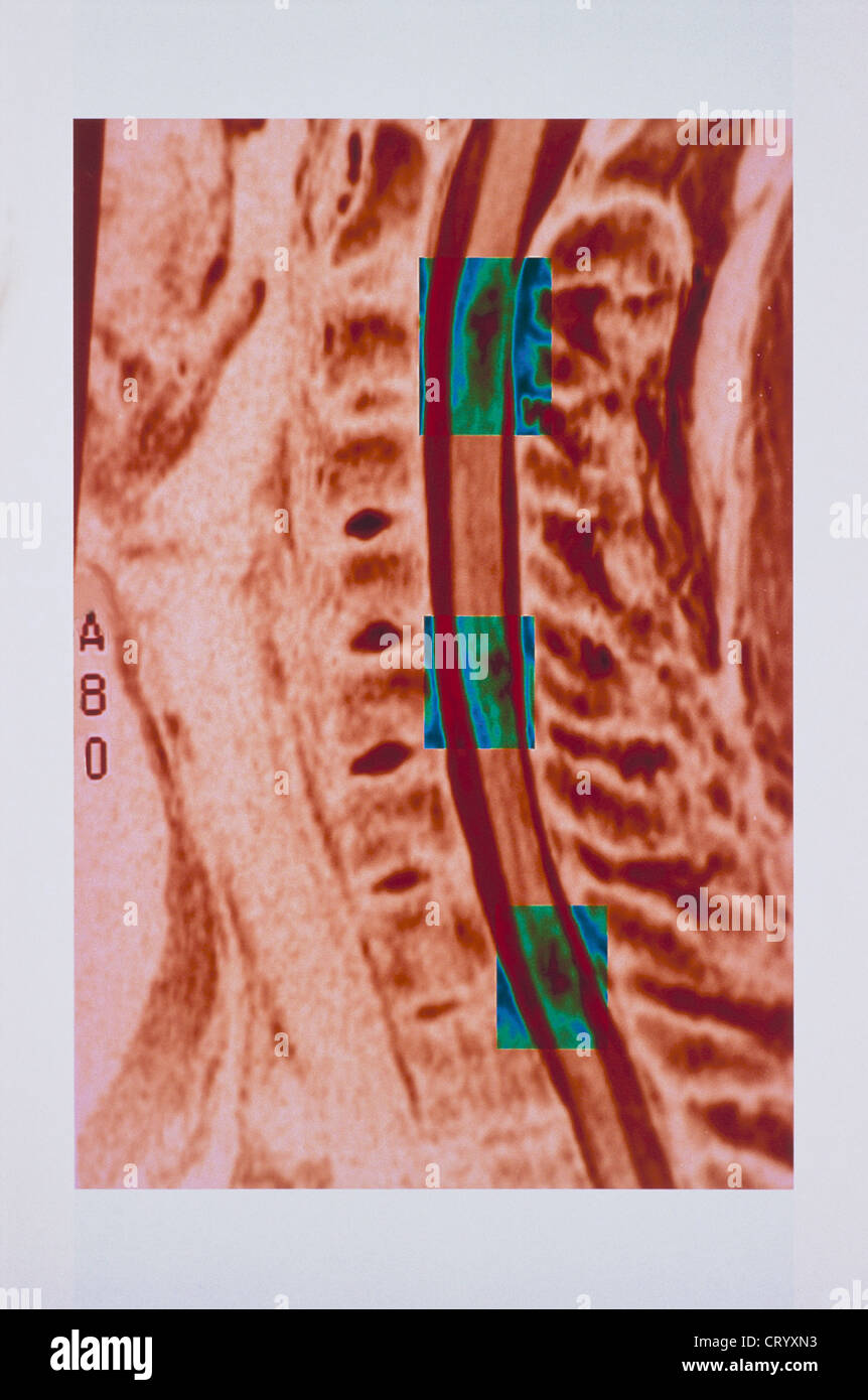 La sclerosi multipla, MRI Foto Stock