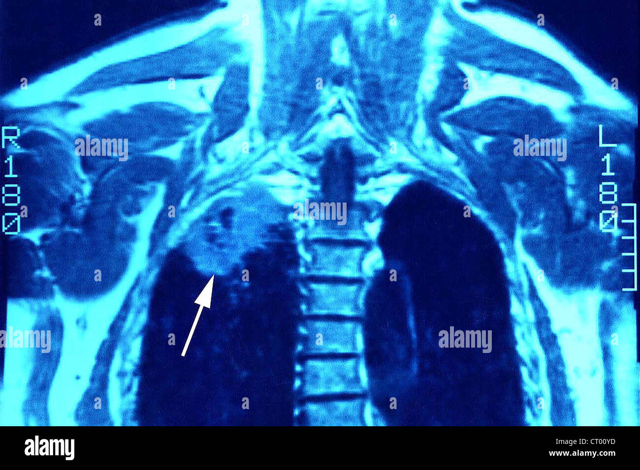 MRI DEL TUMORE DEL POLMONE Foto Stock