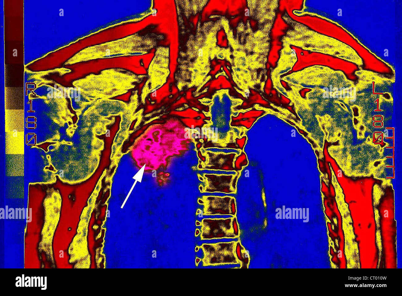 MRI DEL TUMORE DEL POLMONE Foto Stock