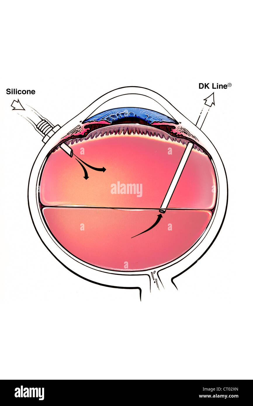 Il distacco della retina, chirurgia Foto Stock