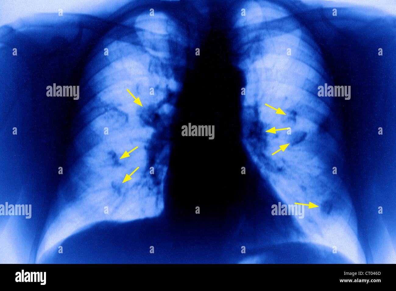 Il cancro del polmone, X-RAY Foto Stock