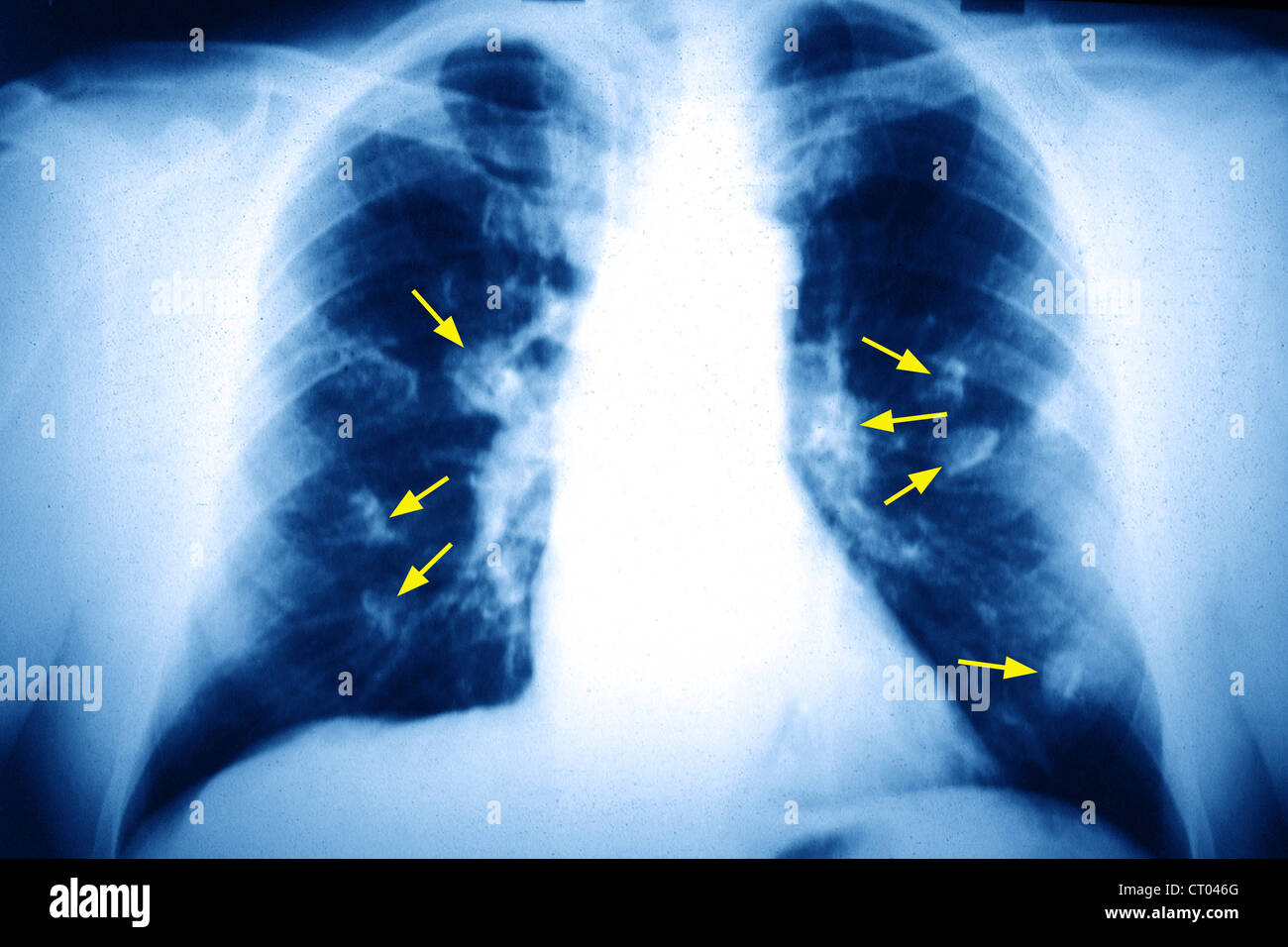 Il cancro del polmone, X-RAY Foto Stock