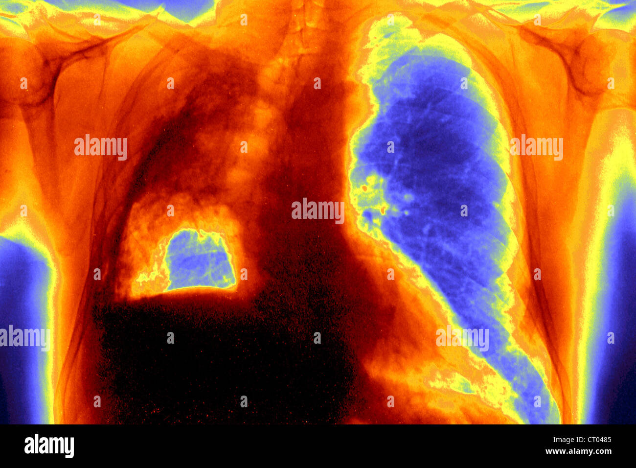 Il cancro del polmone RADIO Foto Stock